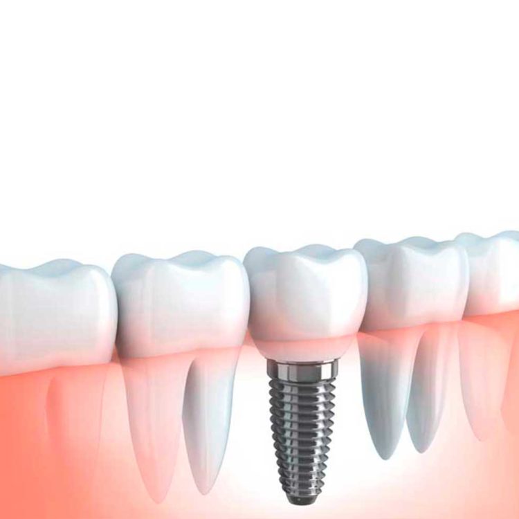 Implantes dentales, santo domingo